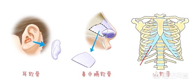 肋软骨隆鼻和耳软骨隆鼻哪个好